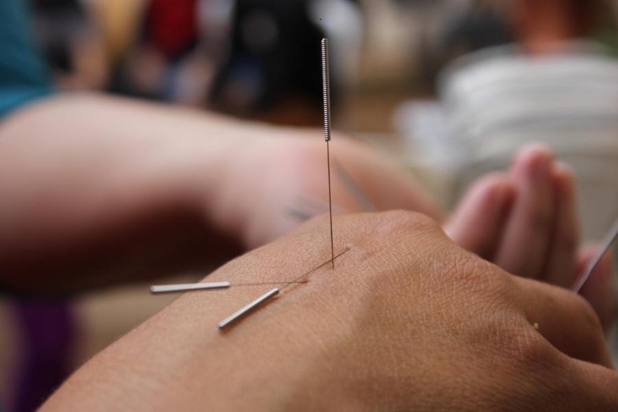 Acupuncture Acupuncture